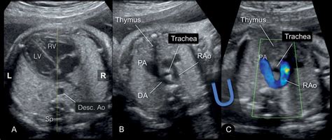 Right Aortic Arch Double Aortic Arch And Aberrant Subclavian Artery Obgyn Key