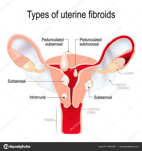 Types De Fibromes Ut Rins Sous S Reuse Intra Muros Sous Muqueuse A