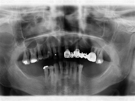 Examples Of Implant Treatments Mudr Jurkovič Phd Mph