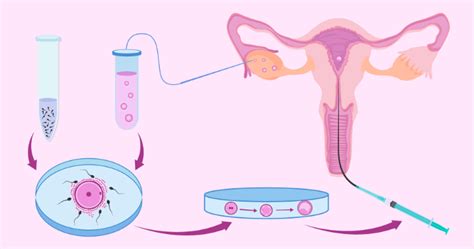 Fertilização In Vitro Preços E Como é Feito O Procedimento Passo A Passo
