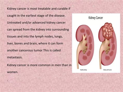 Kidney Cancer Renal Cancer Ppt