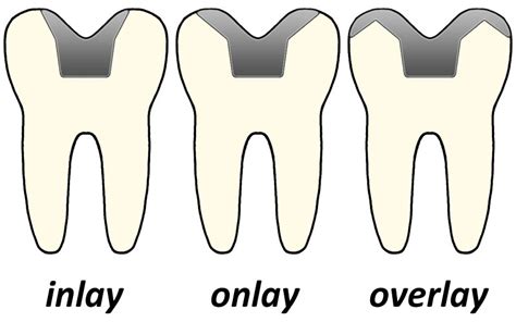 Ceramic Inlays And Onlays Ralev Dental Clinic