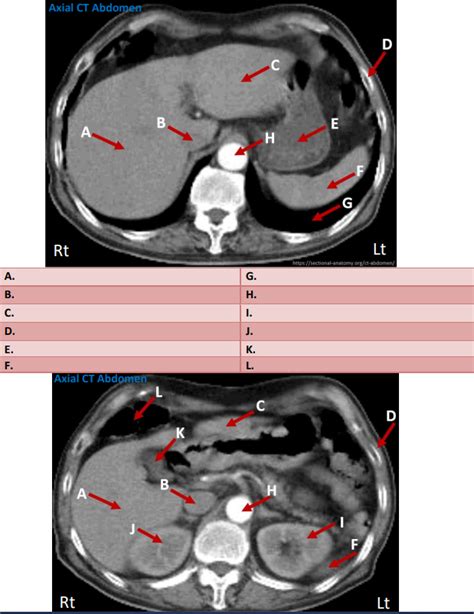 Axial Ct Abdomen Diagram Quizlet