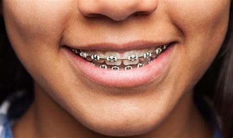 Top Orthodontist Tips For Oral Hygiene With Braces