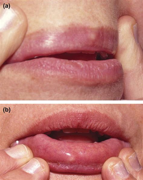 Granulomas Of The Lips A Rare Complication After Injection Of