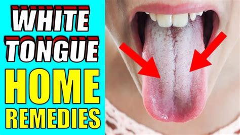 What Causes White Tongue | HOW TO GET RID OF WHITE TONGUE QUICKLY - Epic Natural Health