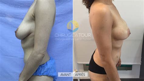 Photos Lipofilling Mammaire Tunisie Chirurgicatour