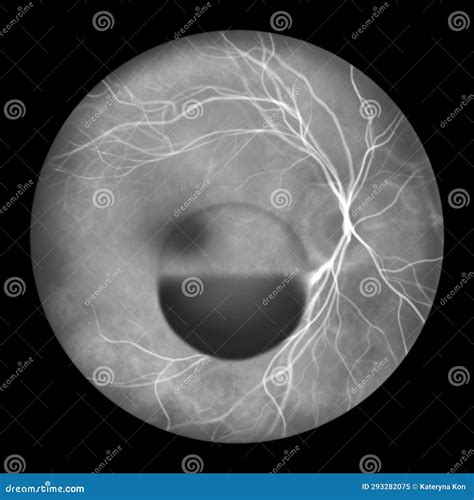 A Subhyaloid Hemorrhage On The Retina As Observed During Ophthalmoscopy