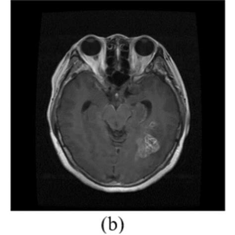 Mri Images Of Three Different Brain Tumors A Meningioma B Glioma And