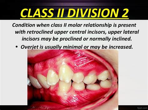 Classification Of Malocclusion