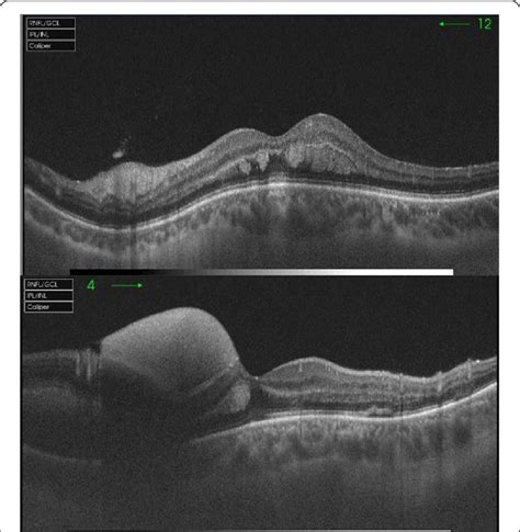 Optical Coherence Tomography Showing Subhyaloid Hemorrhage And