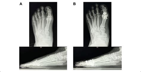 A Preoperative And B 1 Year Postoperative Lateral And Download