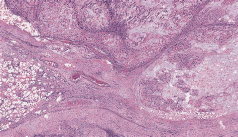 Label Free Photoacoustic Histology For Intraoperative Diagnosis Of Bone