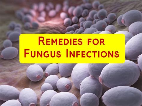 10 Home Remedies for Fungal Infection - Home Remedies App