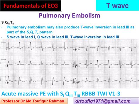 Ecg T Wave Inversion 3