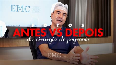 Cirurgia Da Doença De Peyronie Fotos Antes E Depois Dr Paulo