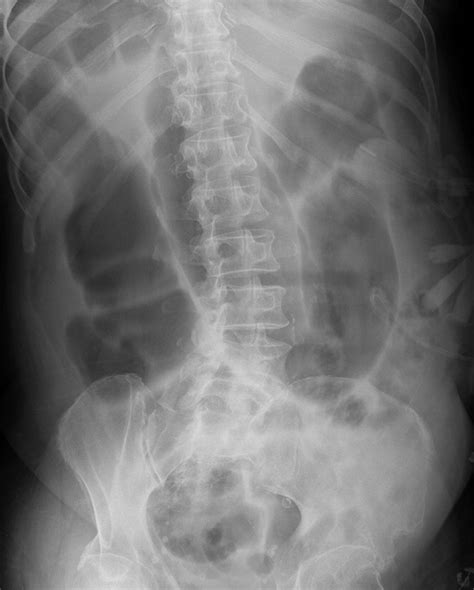 Large Bowel Obstruction In The Adult Classic Radiographic And Ct