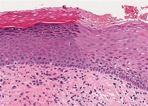 Histological Clonal Change A Feature For Dysplasia Diagnosis