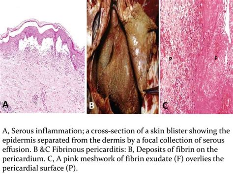 Morphologic Patterns Outcomes Of Acute Inflammation Pptx