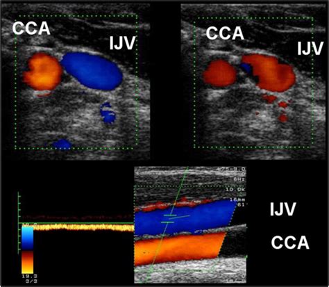 Extracranial Color Coded Duplex Sonography Of The Internal Jugular Vein