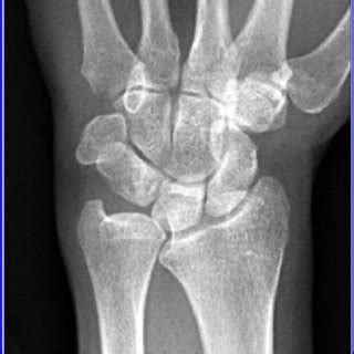 Posteroanterior Radiograph Of The Left Wrist Showing Positive Ulnar