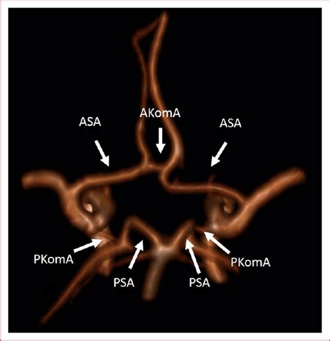 D Tof Mra Image Of The Vessels Forming The Willis Polygon Aca