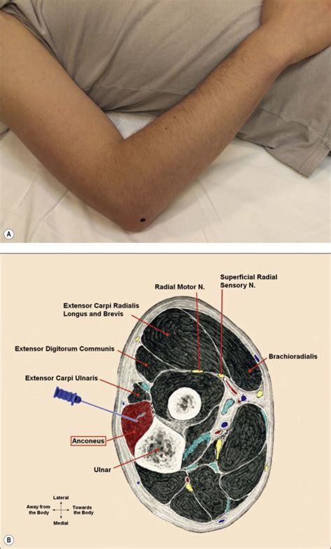 Anatomy for Needle Electromyography | Musculoskeletal Key