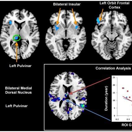 The Cold Color Denotes The Brain Regions Having Reduced Gray Matter