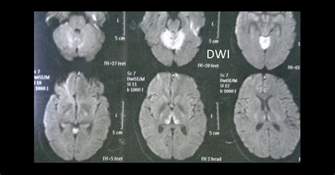 Wernicke Korsakoffs Encephalopathy Thiamine Deficiency Manal S