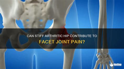 Can Stiff Arthritic Hip Contribute To Facet Joint Pain MedShun