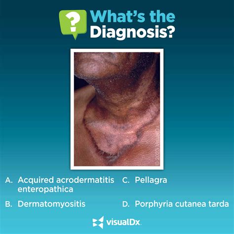 Image Challenge! Itchy, burning lesions shaped like a V | VisualDx