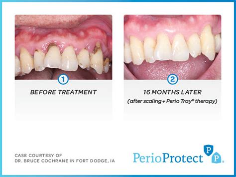 Perio Protect - Premier Dental Center