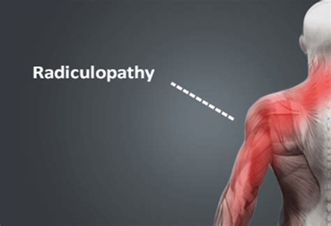 Radiculopathy Facts and Treatment | All Star Pain Management ...