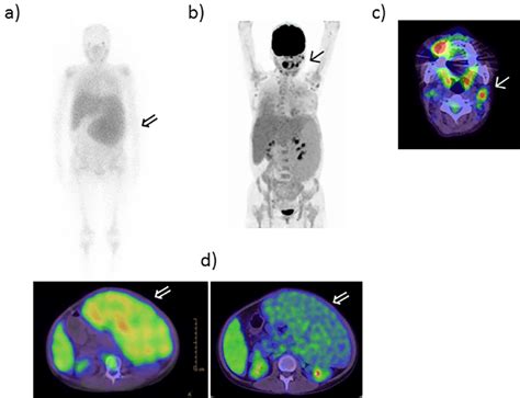 Figure2gallium And Pet Ct Scans A Gallium Scan And B D Pet Ct