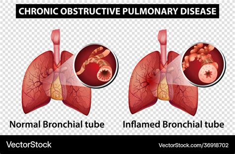 Diagram Showing Chronic Obstructive Pulmonary Vector Image