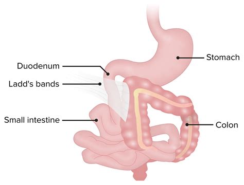 Obstrucci N Duodenal Cong Nita Concise Medical Knowledge