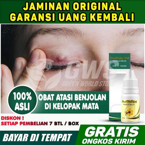 Jual Obat Benjolan Di Kelopak Mata Mata Bintitan Benjolan Kalazion