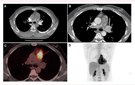 Figure 1 From Complete Resection Of A Pulmonary Artery Sarcoma