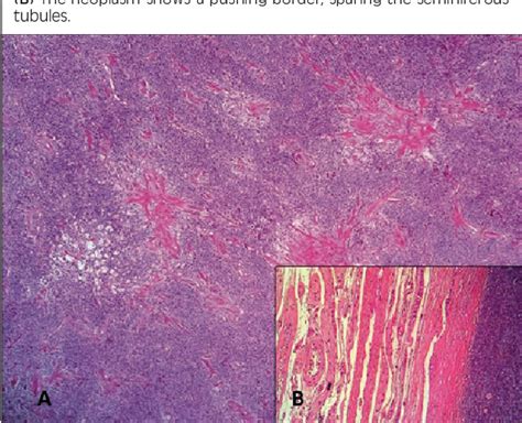 Figure 2 From Unclassified Sex Cordgonadal Stromal Testis Tumor With A