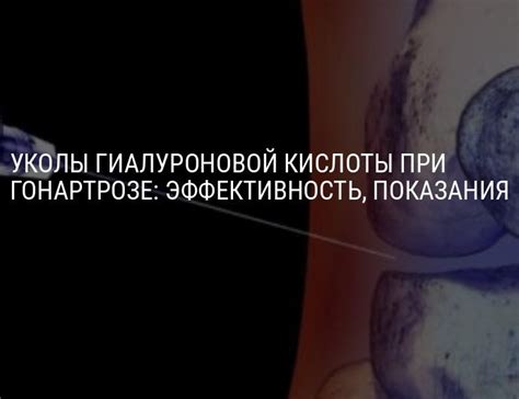 Уколы гиалуроновой кислоты в коленный сустав при гонартрозе, артрозе ...