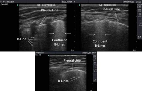 B-lines and confluent B-lines consistent with viral pneumonia lung ...