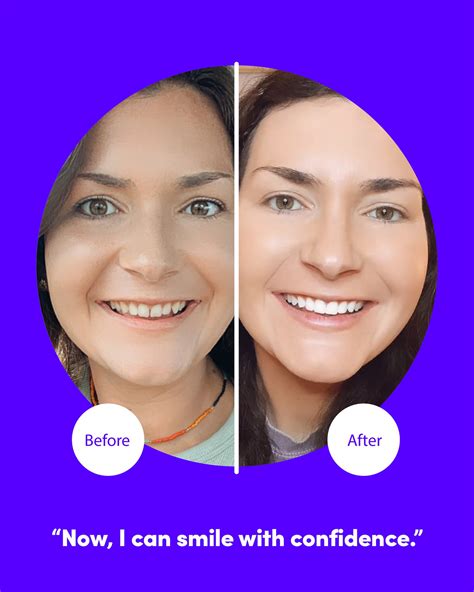 smile direct club whitening 5