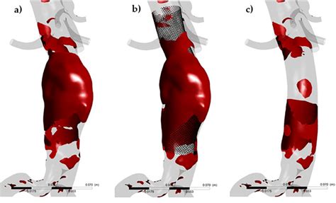 Blood Stagnation Comparison At The Same Time Step During Peak Systole