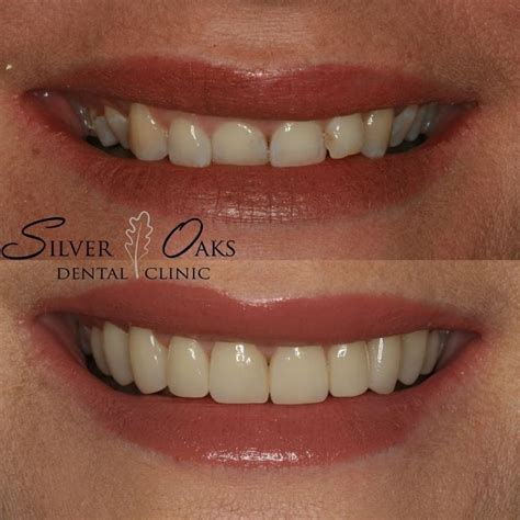 The Cost Of Dental Veneers Silver Oaks Dental Clinic