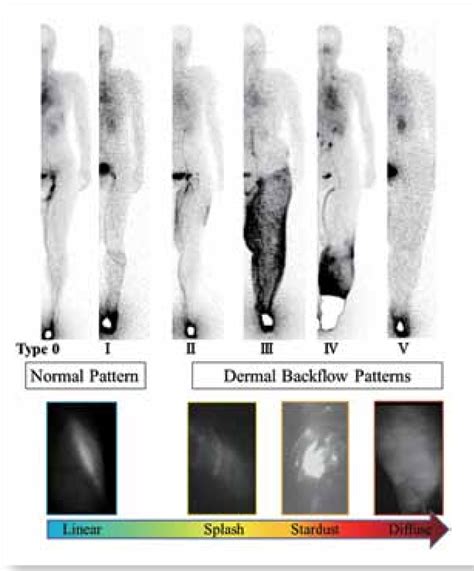 Lymphedema praecox | Semantic Scholar