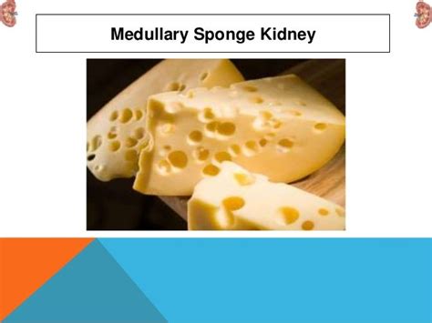 Medullary Sponge Kidney Msk