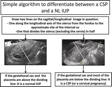 A Consequence Of Cesarean Delivery First Trimester Cesarean Scar