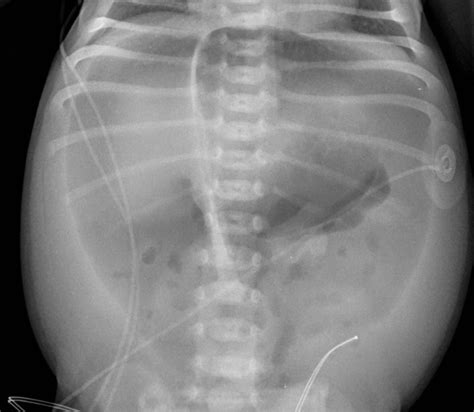 Classic Radiological Sign On A Kub Football Sign Radrounds Radiology