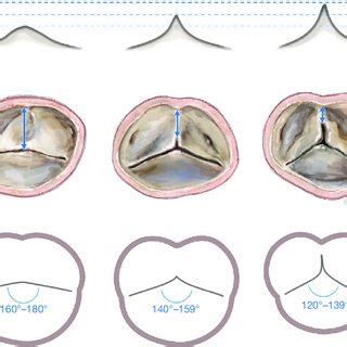 PDF Bicuspid Aortic Valve Repair The 180 Reimplantation Technique