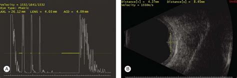 Diagnostic Ophthalmic Ultrasound | Radiology Key